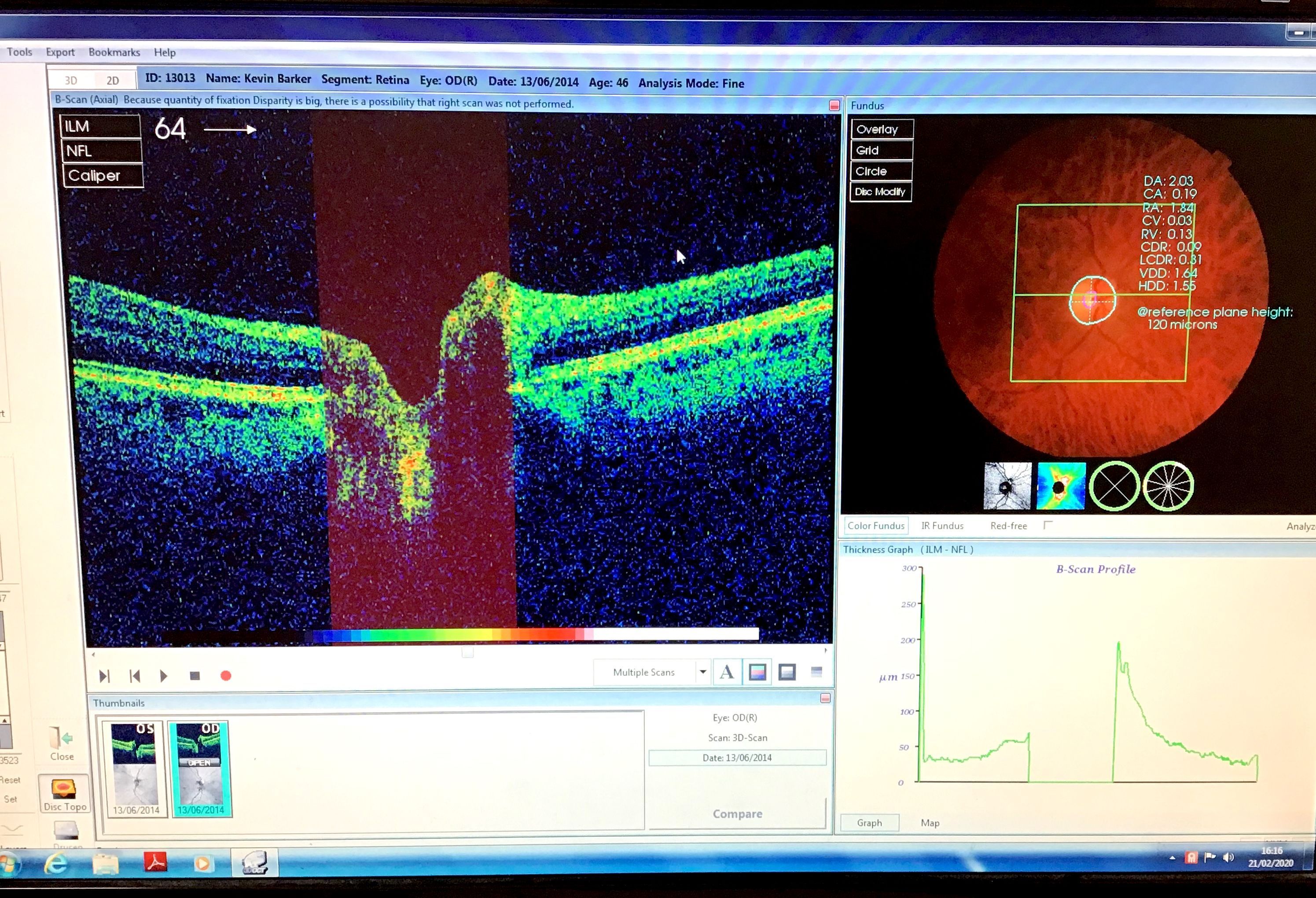 eye test machine Digital Retinal Imaging